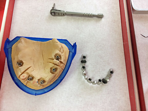 Brückengerüst zur Anprobe auf Implantaten